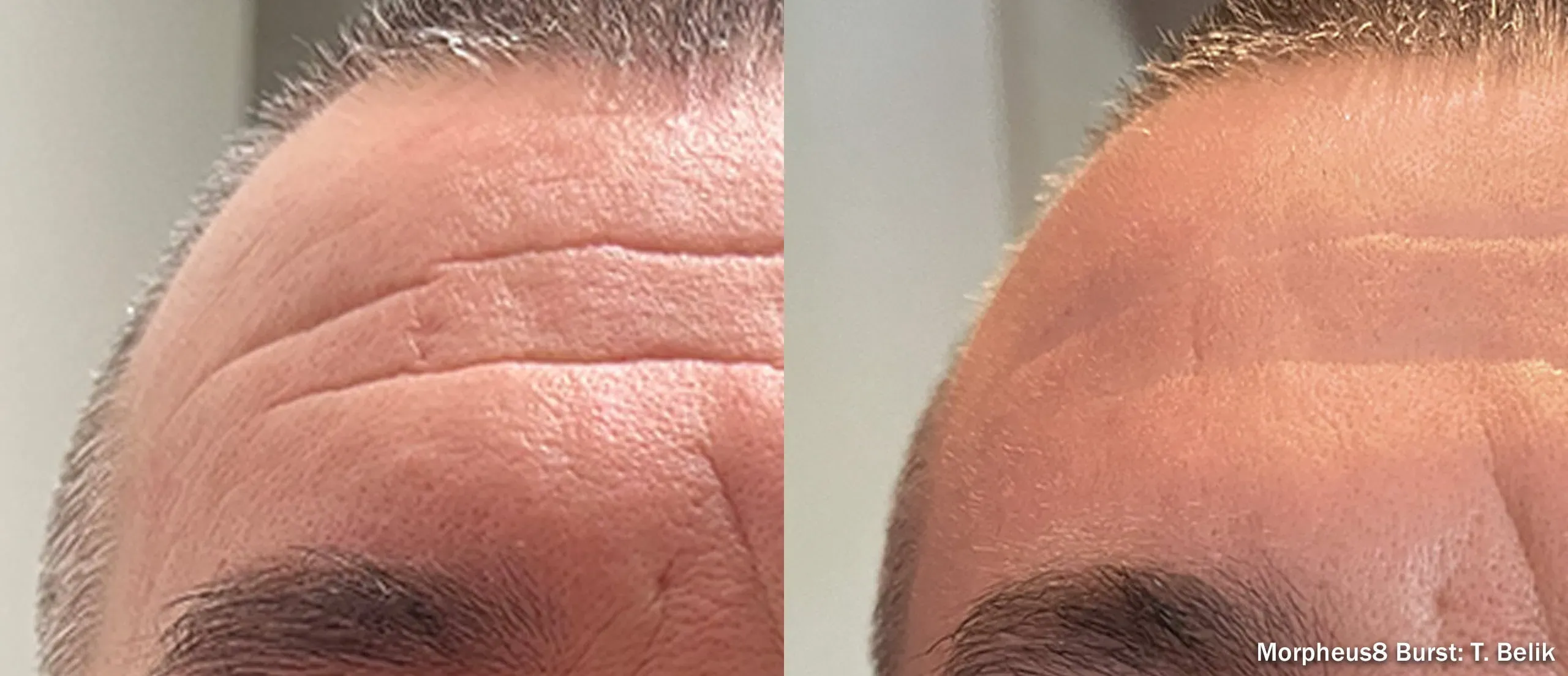 Morpheus8 Burst forehead before and after